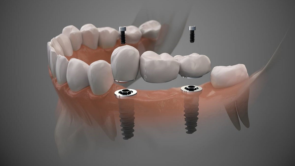 Implantes e Próteses